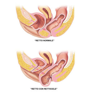 Il rettocele è un rigonfiamento della parete anteriore del retto nella parete posteriore della vagina.